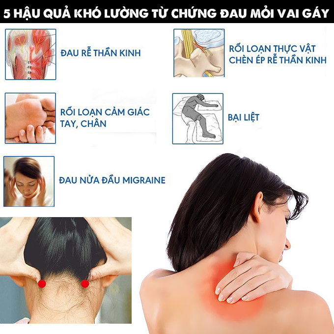đau mỏi vai gáy dẫn đến đau đầu và nhiều bệnh khác