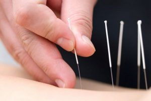 châm cứu chữa thoát vị đĩa đệm rất tốt