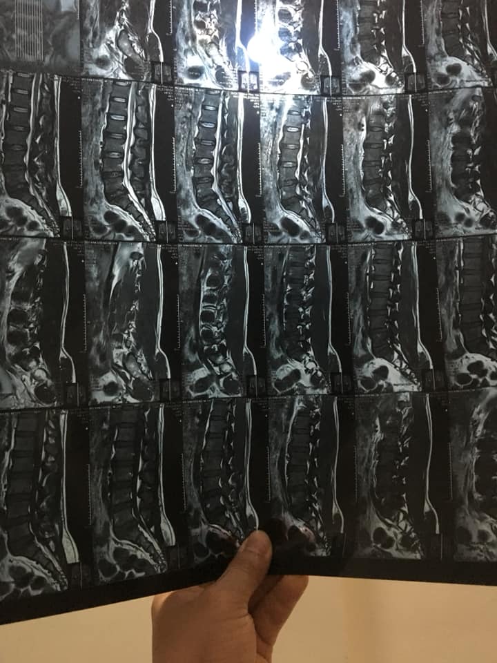 chụp MRI chuẩn đoán thoát vị đĩa đệm