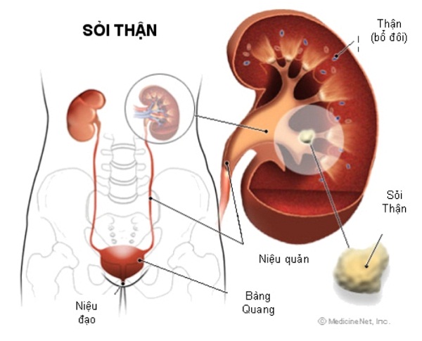 bệnh sỏi thận, sỏi túi mật