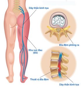 bệnh thần kinh tọa