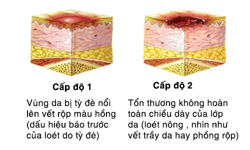 cấp độ 1, cấp độ 2 của vết lở loét do tỳ đè