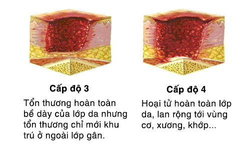 cấp độ 3 và 4 của vết lở loét do tì đè
