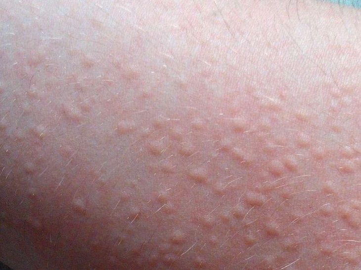 dị ứng ngứa nổi mề đay