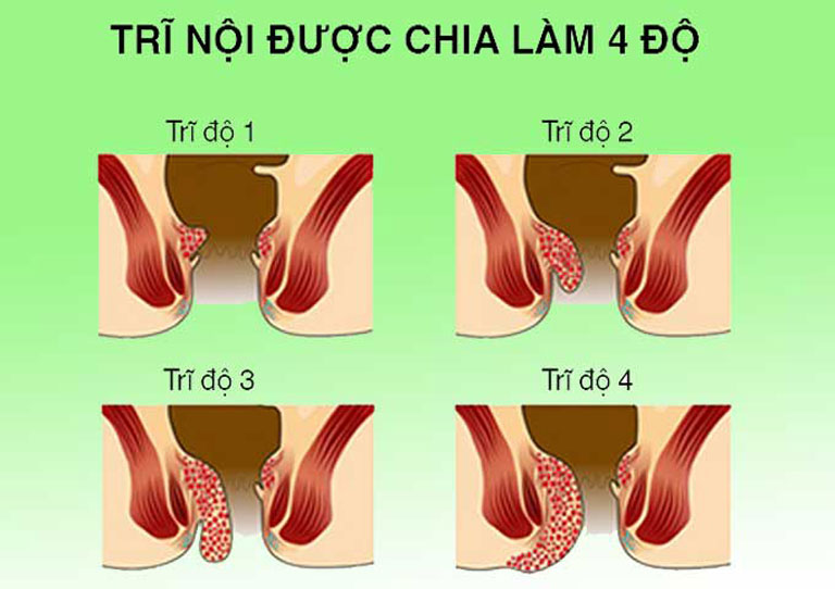 phân loại bệnh trĩ