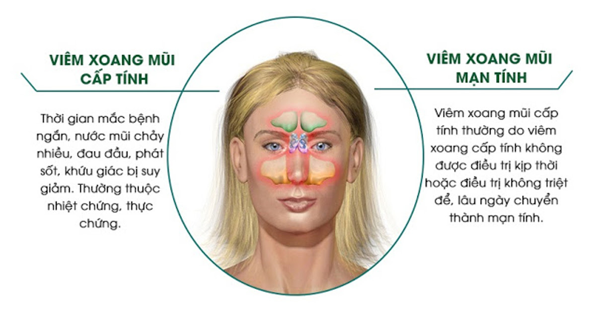 triệu chứng viêm xoang mũi cấp và mạn tính