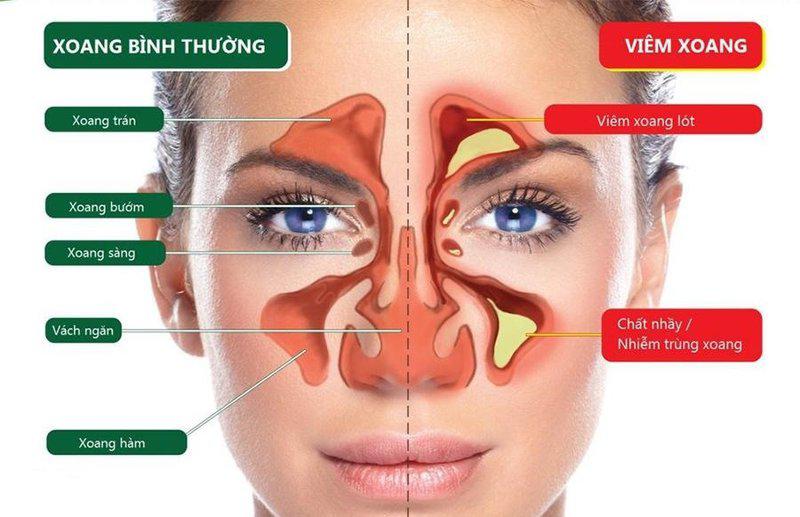 Viêm xoang mũi: tắc mũi, đau đầu, chảy nước mũi, khứu giác giảm